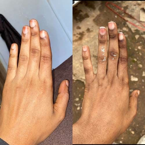 Knuckle brightening Kit(mild brightening)