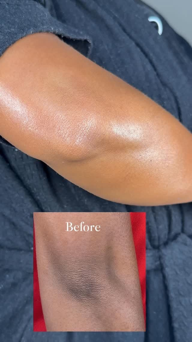 Hyperpigmentation scrub and lotion! (Noticeable results in 3 weeks)