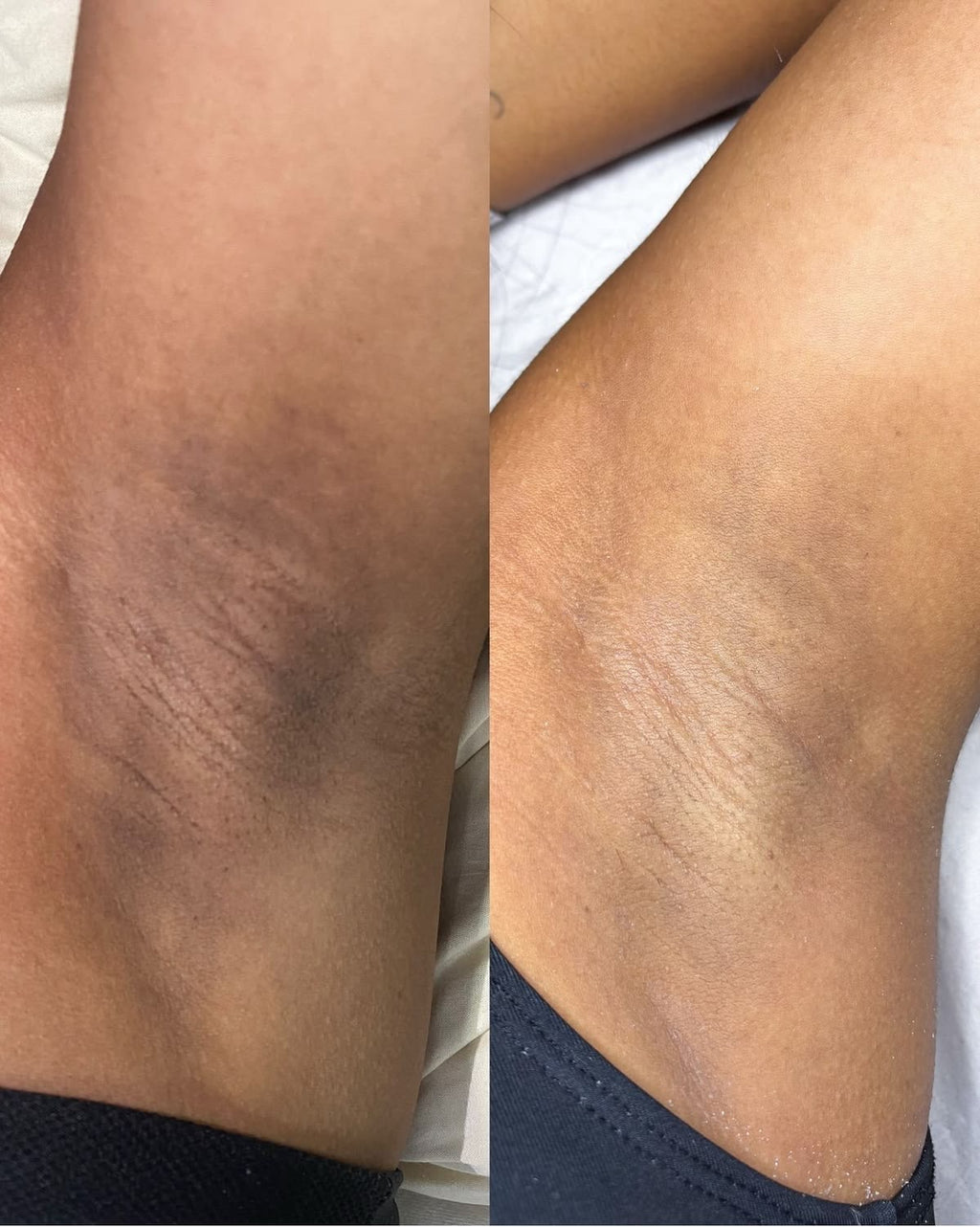 1L HYPER PIGMENTATION CLEARING SOAP
