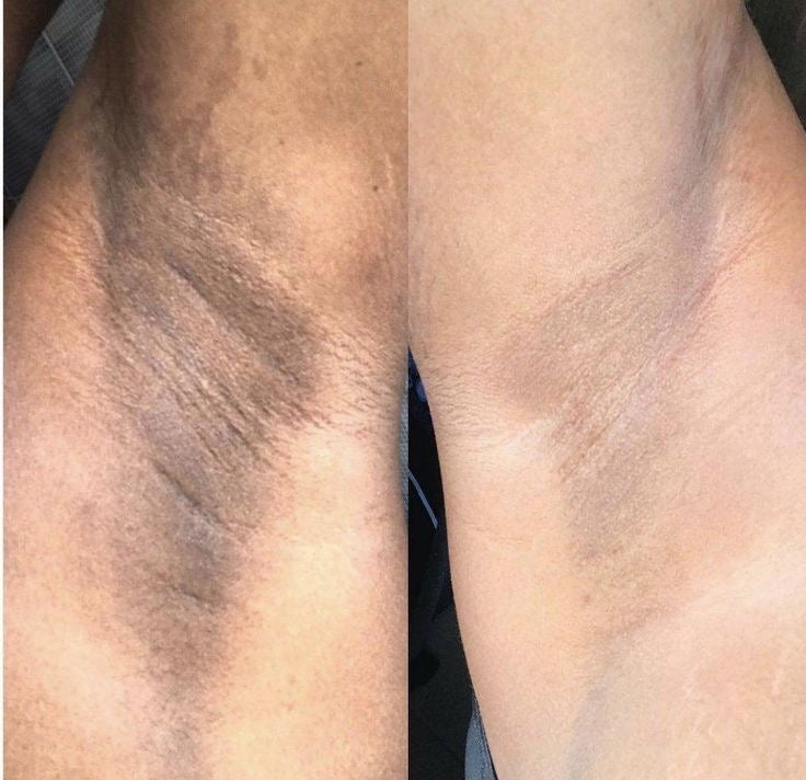 Hyperpigmentation scrub and lotion! (Noticeable results in 3 weeks)